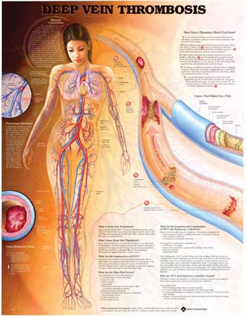 Deep Vein Thrombosis Anatomical Chart