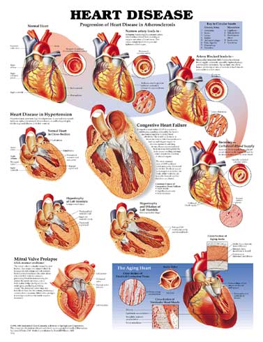 Heart Disease Anatomical Chart