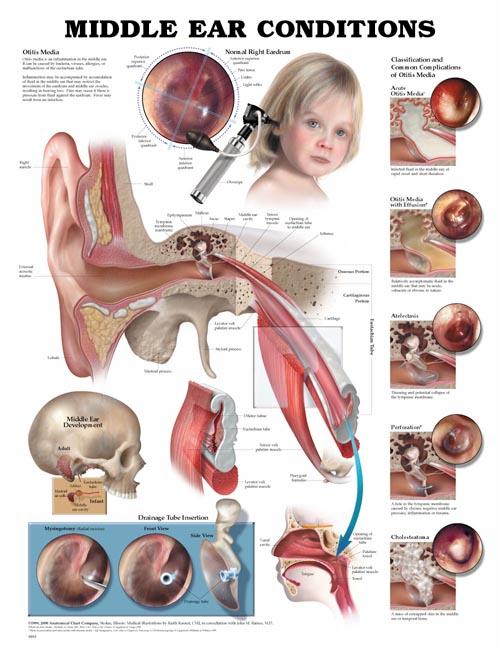 Middle Ear Conditions Anatomical Chart