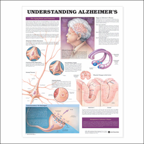 Understanding Alzheimer's Anatomical Chart