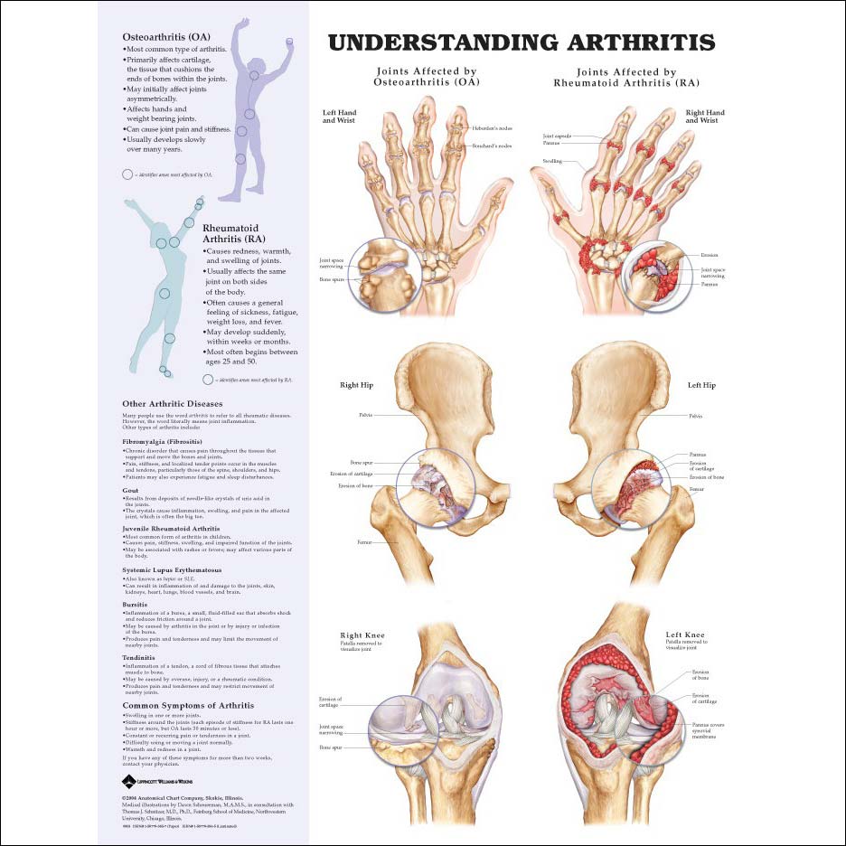 Understanding Arthritis Anatomical Chart