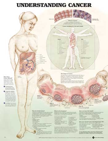 Understanding Cancer Anatomical Chart