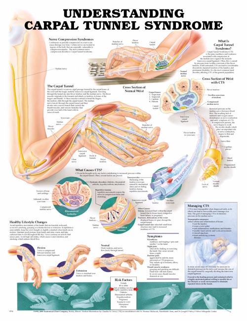 Understanding Carpal Tunnel Syndrome Anatomical Chart