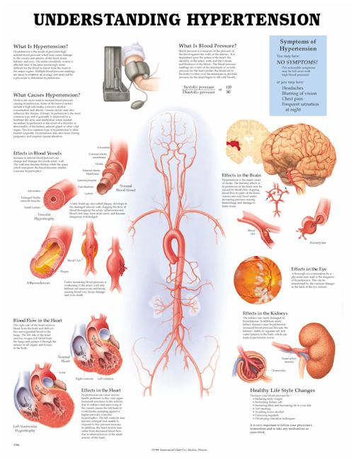 Understanding Hypertension Anatomical Chart