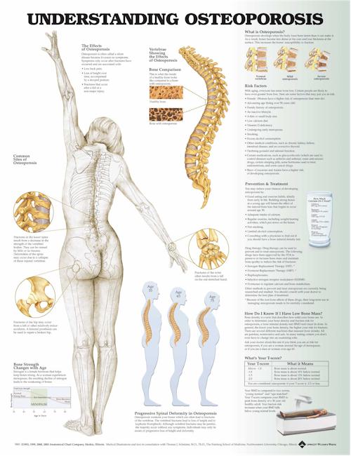 Understanding Osteoporosis Anatomical Chart
