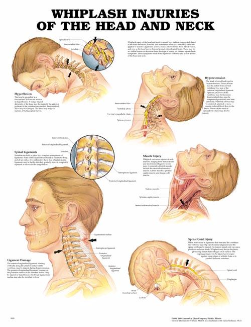 Whiplash Injuries of the Head and Neck Anatomical Chart