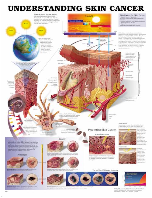 Understanding Skin Cancer Anatomical Chart